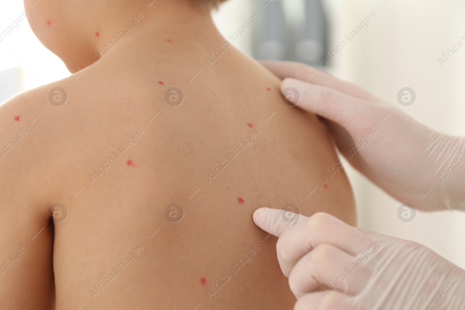 Photo of Doctor examining little boy with chickenpox in clinic, closeup. Varicella zoster virus