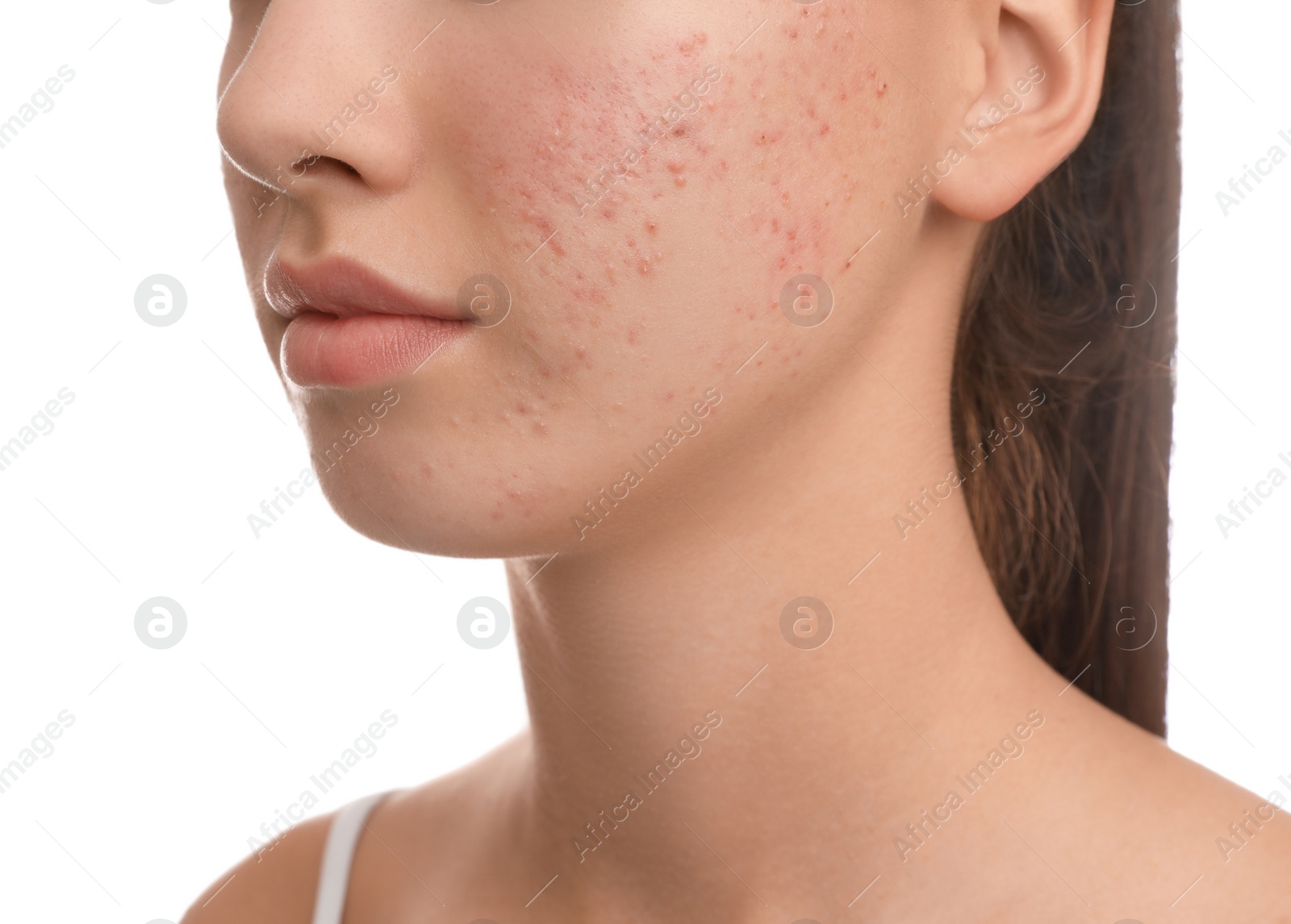 Photo of Teenage girl with acne problem on white background, closeup