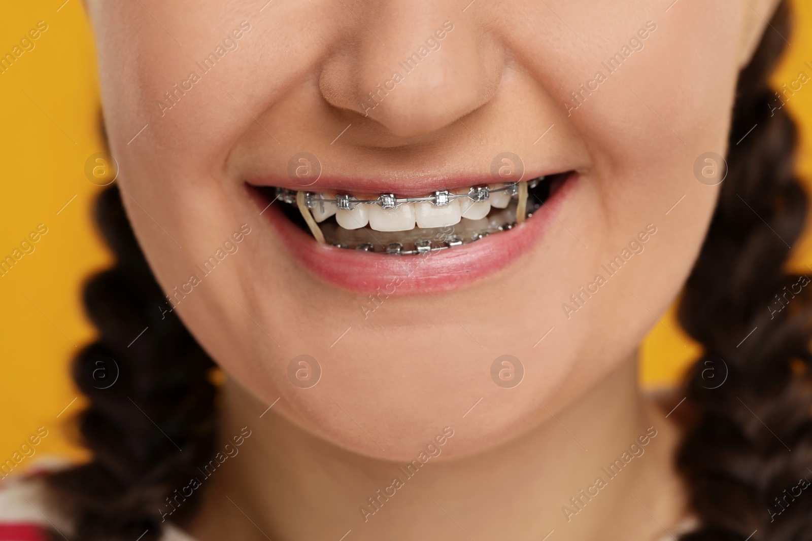 Photo of Smiling woman with dental braces and orthodontic elastics on orange background, closeup