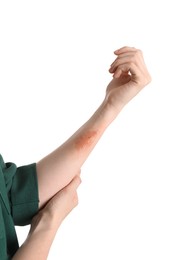 Photo of Woman with burned hand on white background, closeup