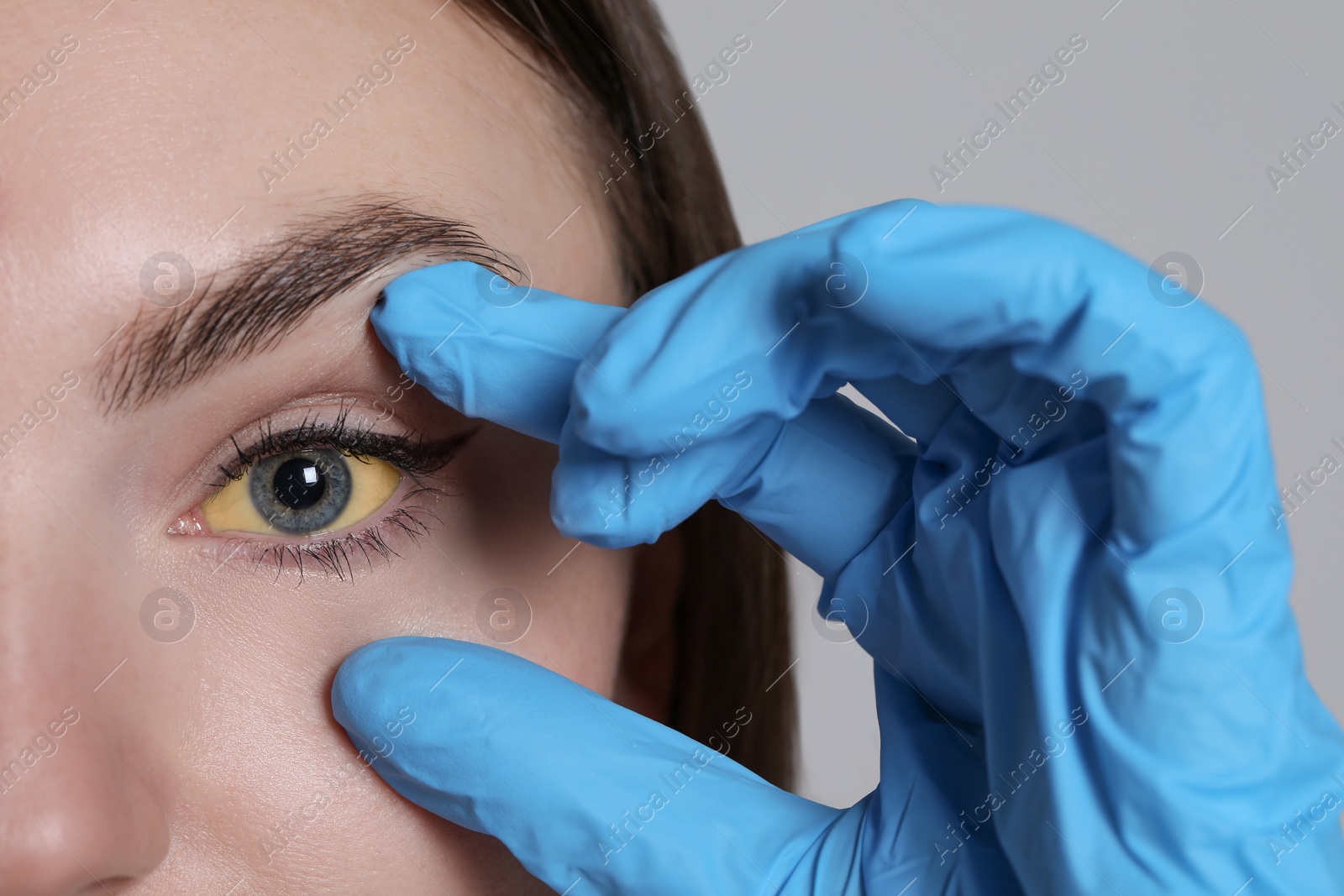 Photo of Woman checking her health condition on light grey background, closeup. Yellow eyes as symptom of hepatitis