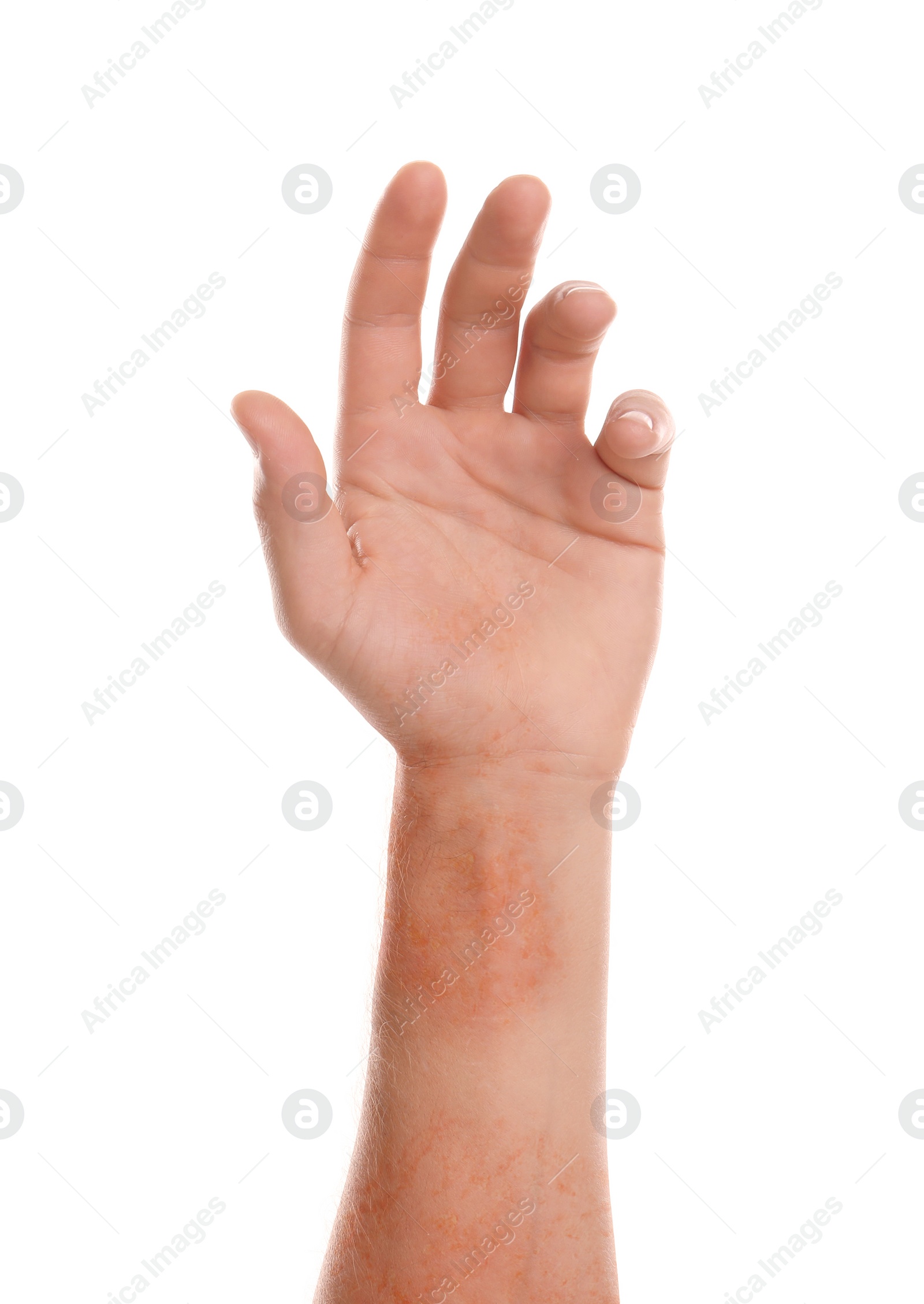 Image of Man showing hand with dry skin on white background, closeup