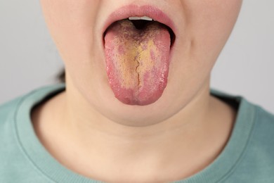 Photo of Gastrointestinal diseases. Woman showing her yellow tongue on light grey background, closeup