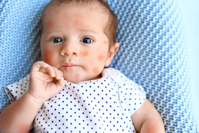 Little child with red rash on light blue plaid, top view. Baby allergies