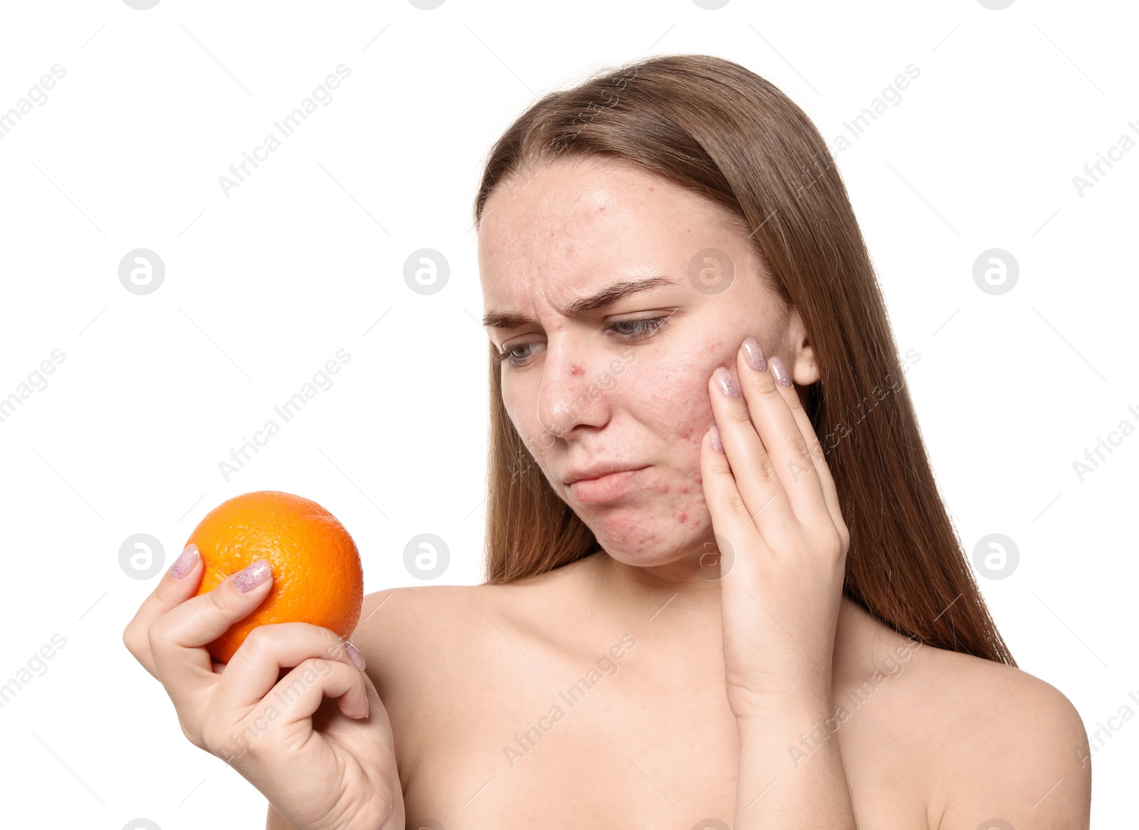 Photo of Young woman with acne problem holding orange on white background. Skin allergy