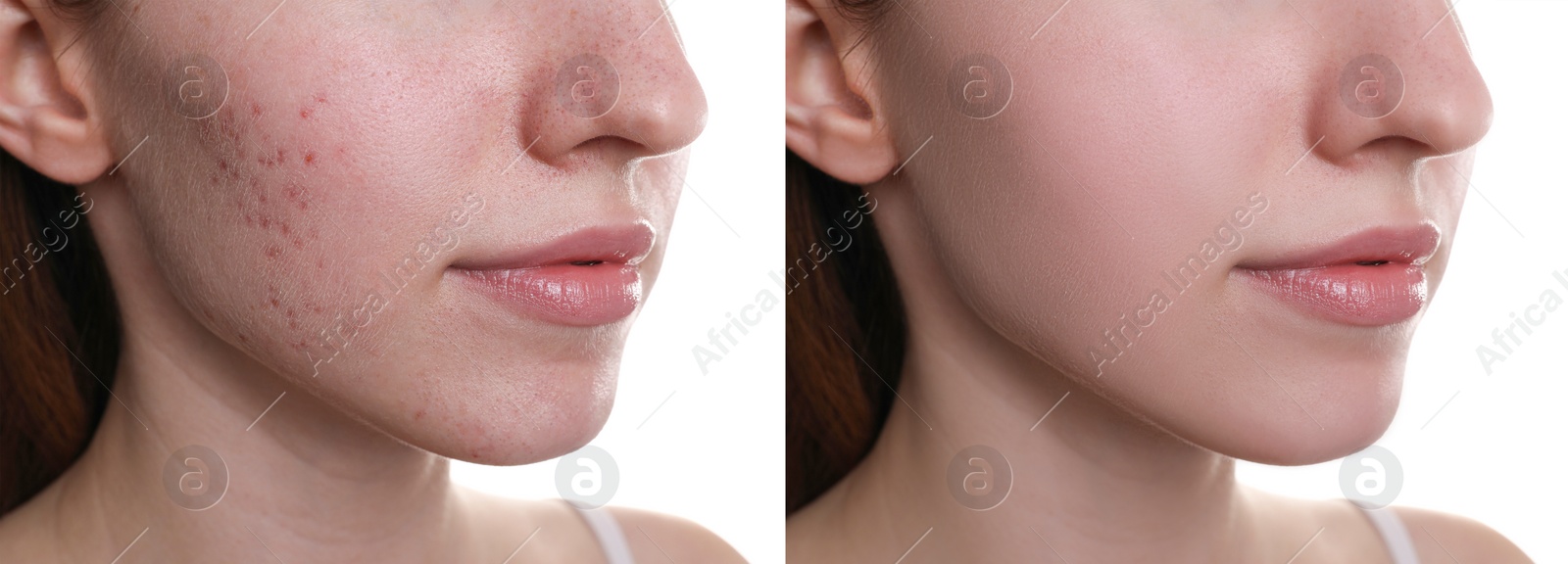 Image of Acne problem. Young woman before and after treatment on white background, closeup. Collage of photos