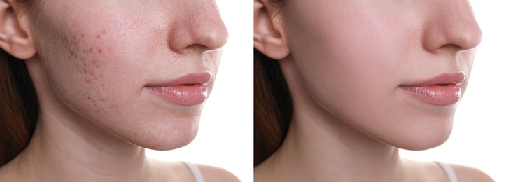 Acne problem. Young woman before and after treatment on white background, closeup. Collage of photos