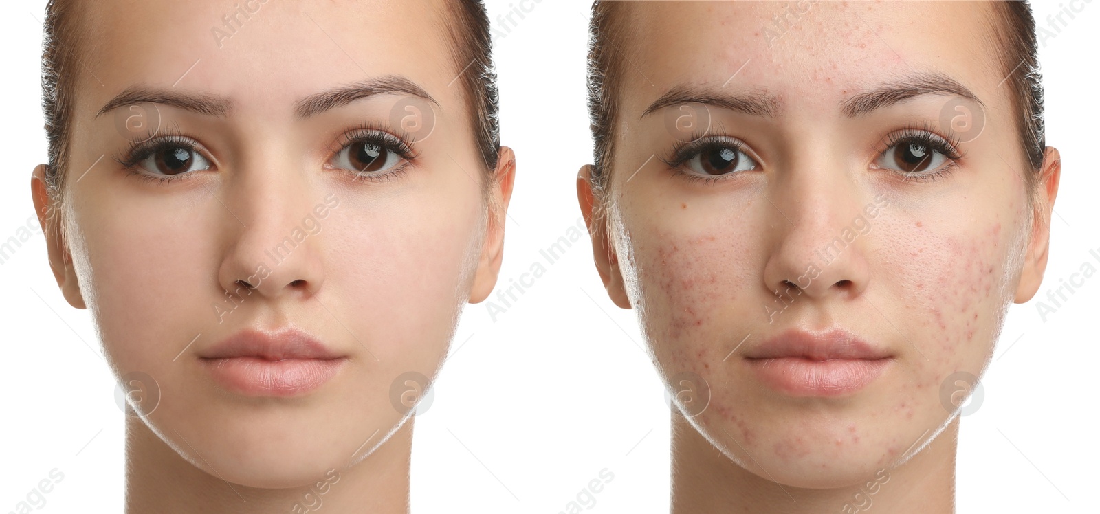 Image of Collage with photos of teenage girl with acne problem before and after treatment on white background. Banner design