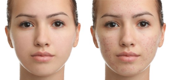 Image of Collage with photos of teenage girl with acne problem before and after treatment on white background. Banner design