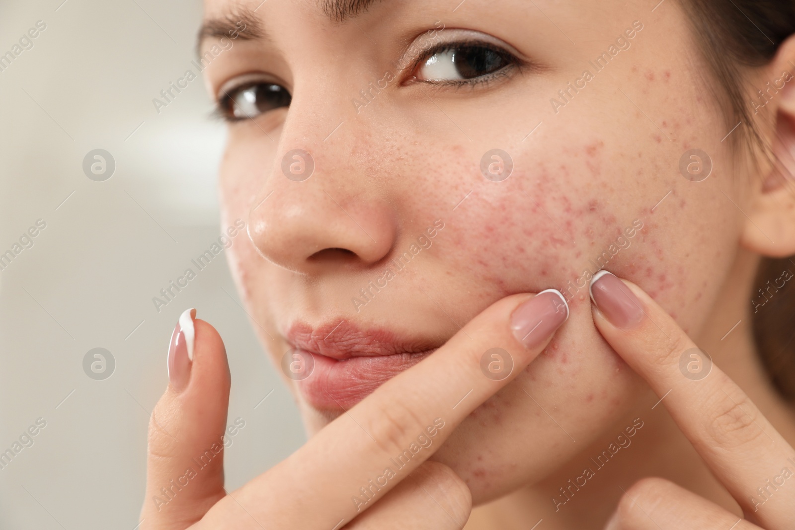 Photo of Teen girl with acne problem squeezing pimple on her face, closeup