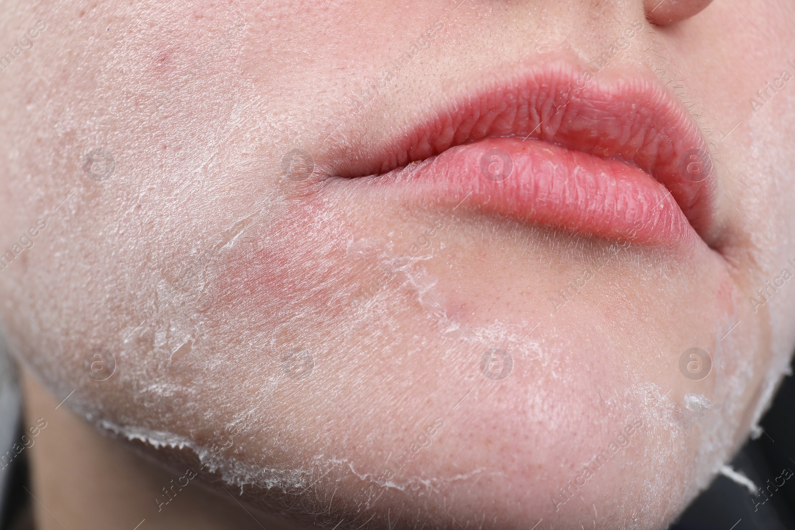 Photo of Woman with dry skin on face, closeup