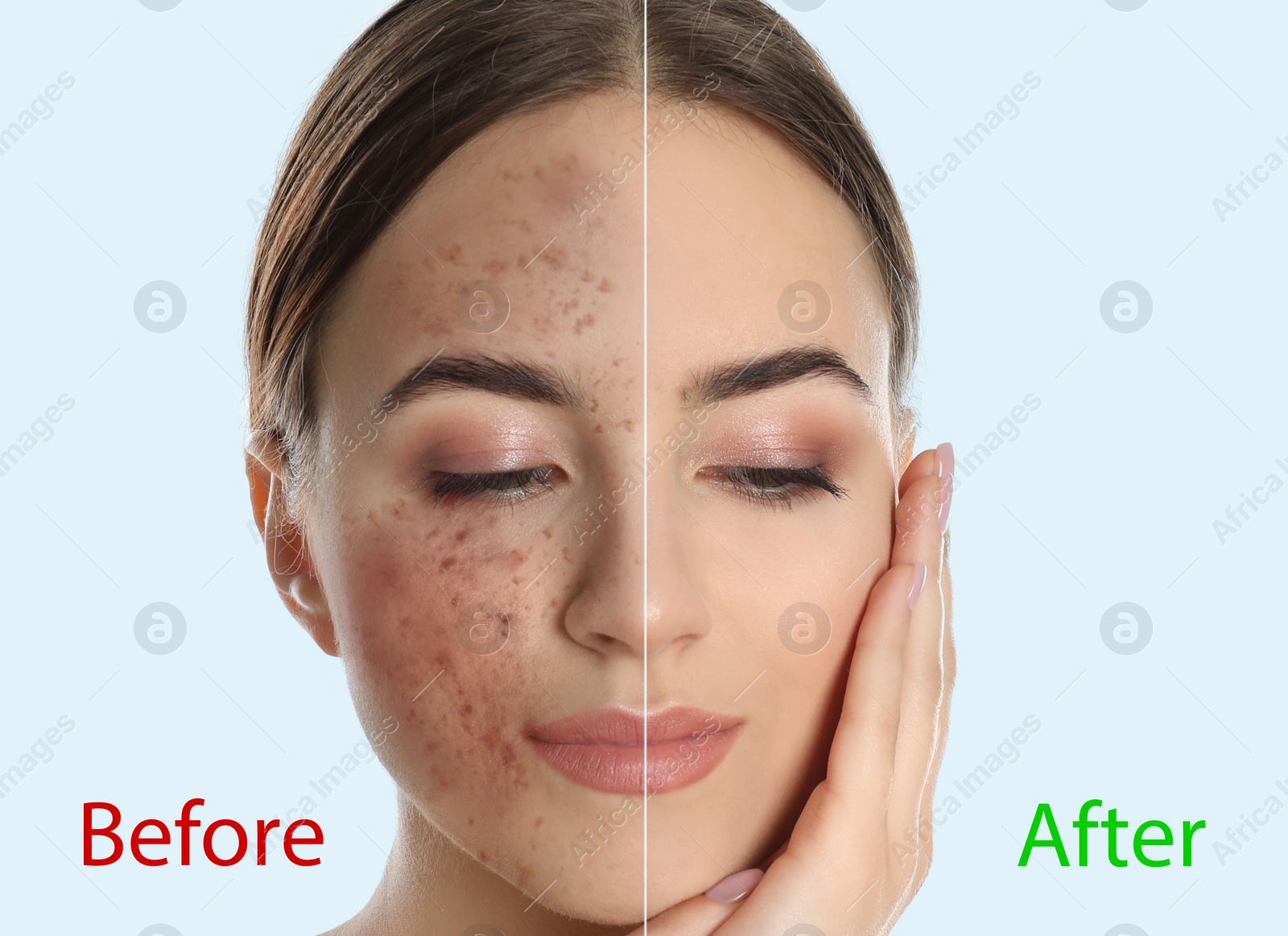Image of Young woman before and after cosmetic procedure on light background