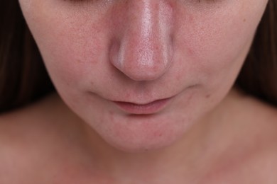 Photo of Closeup view of woman with blackheads on her nose
