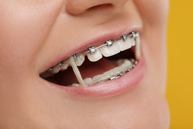 Photo of Smiling woman with dental braces and orthodontic elastics on orange background, closeup