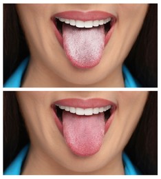 Image of Collage with photos of woman before and after tongue cleaning, closeup