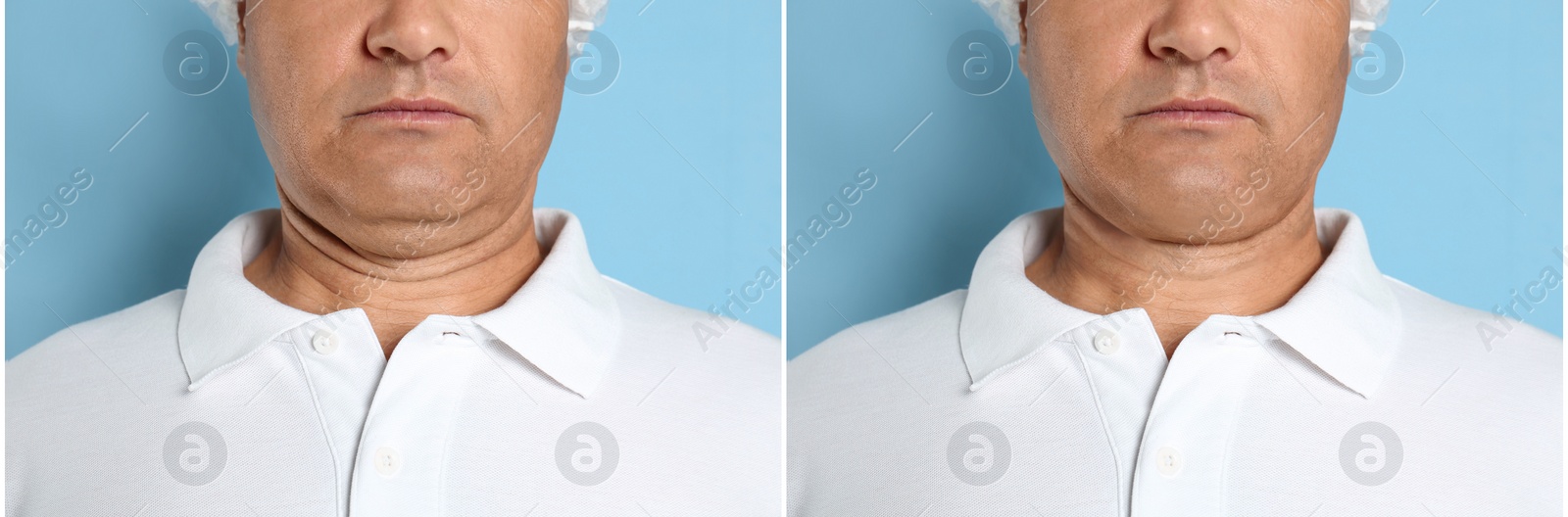 Image of Mature man before and after plastic surgery operation on blue background, closeup. Double chin problem