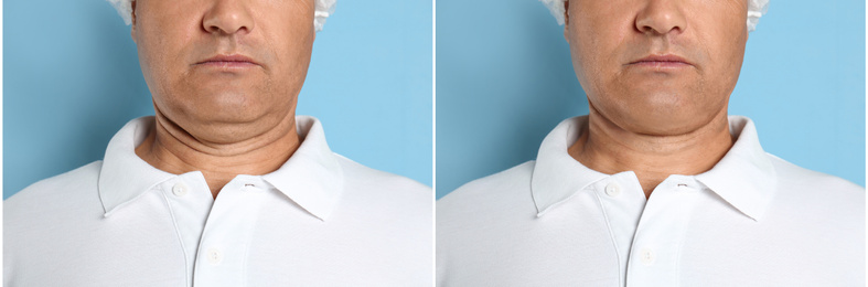 Image of Mature man before and after plastic surgery operation on blue background, closeup. Double chin problem