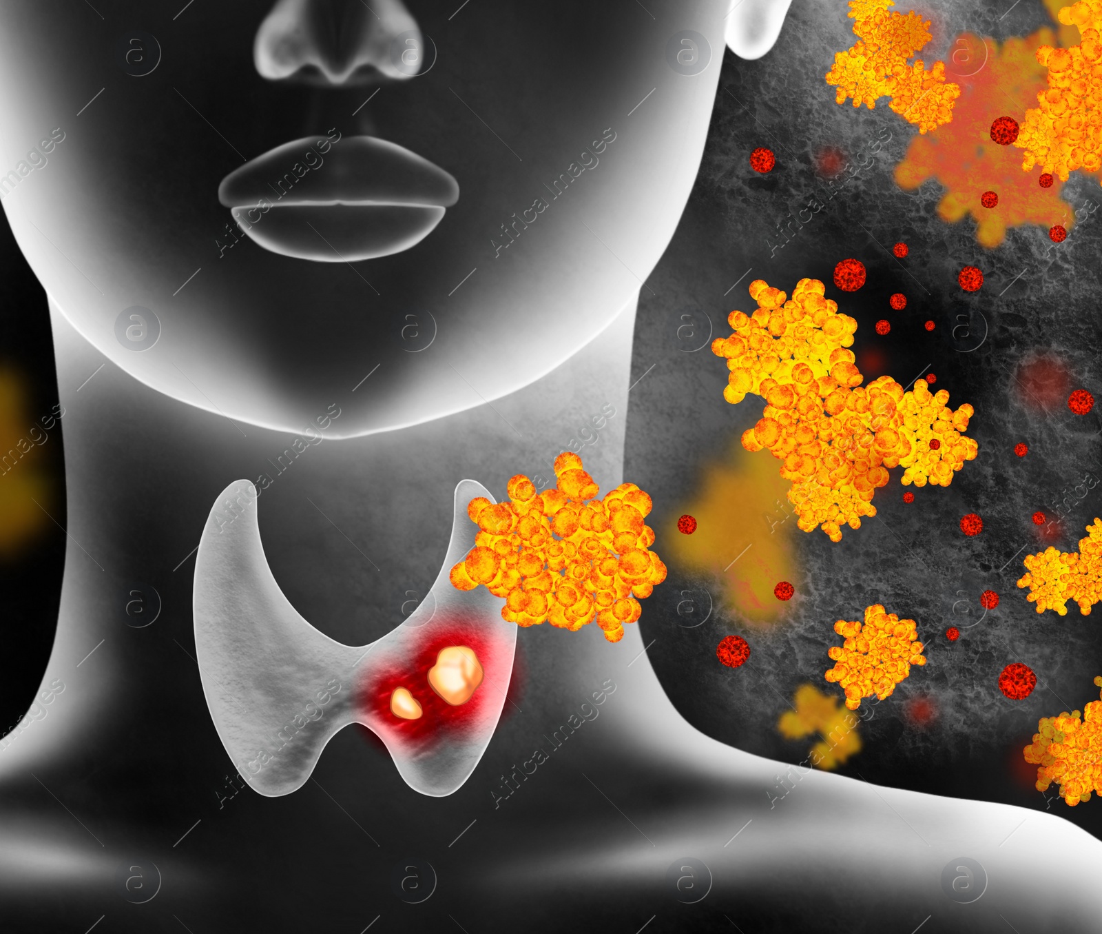 Illustration of  human thyroid cancer on color background