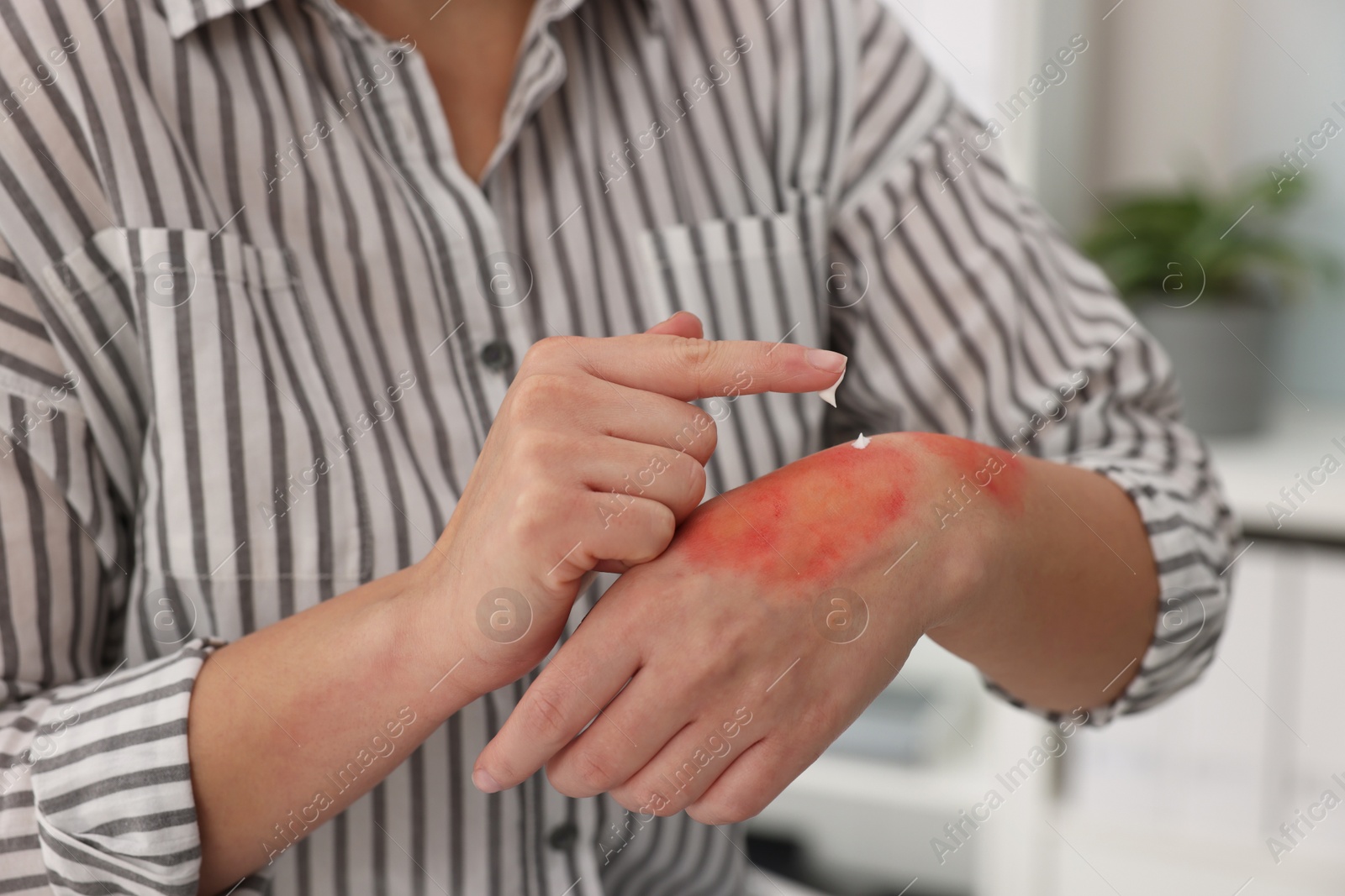 Photo of Woman applying healing cream onto burned hand indoors, closeup