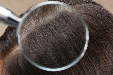 Photo of Closeup of woman with dandruff in her hair, view through magnifying glass