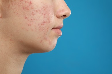 Photo of Teenage girl with acne problem on blue background, closeup