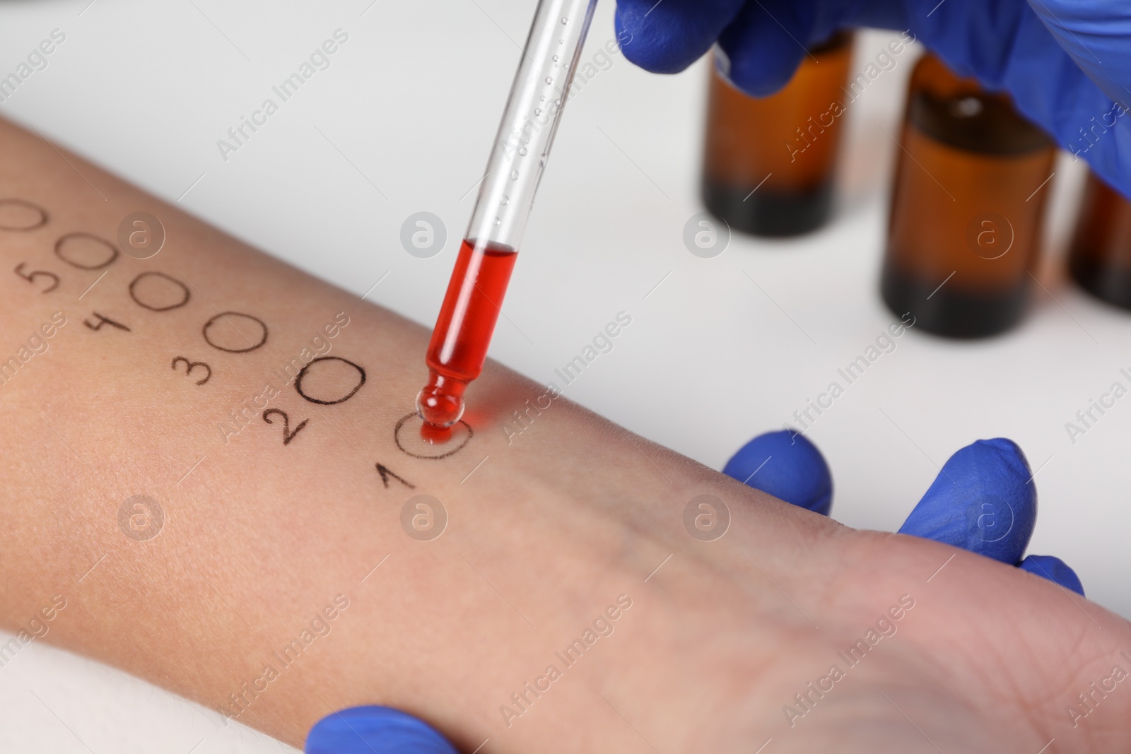 Photo of Patient undergoing skin allergy test at light table in clinic, closeup