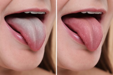 Image of Woman showing her tongue before and after cleaning procedure, closeup. Tongue coated with plaque on one side and healthy on other, collage