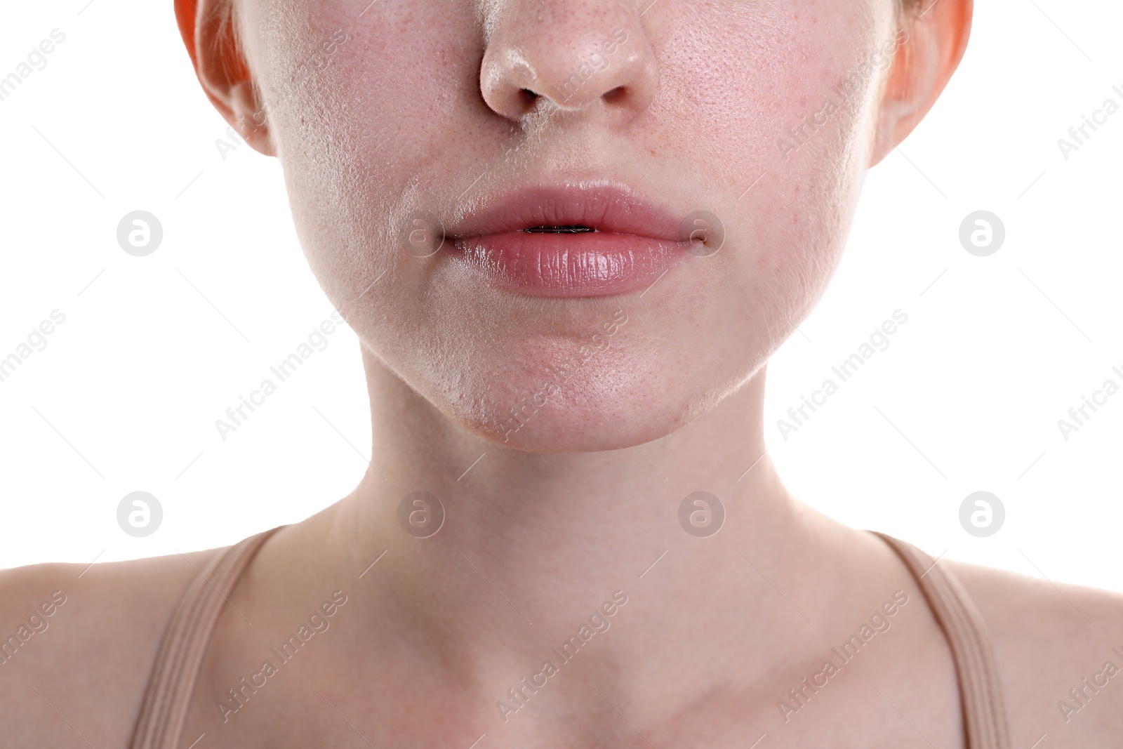 Photo of Young woman with acne problem on white background, closeup