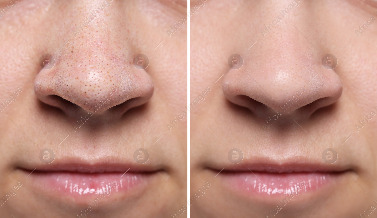 Image of Blackhead treatment, before and after. Collage with photos of woman, closeup view