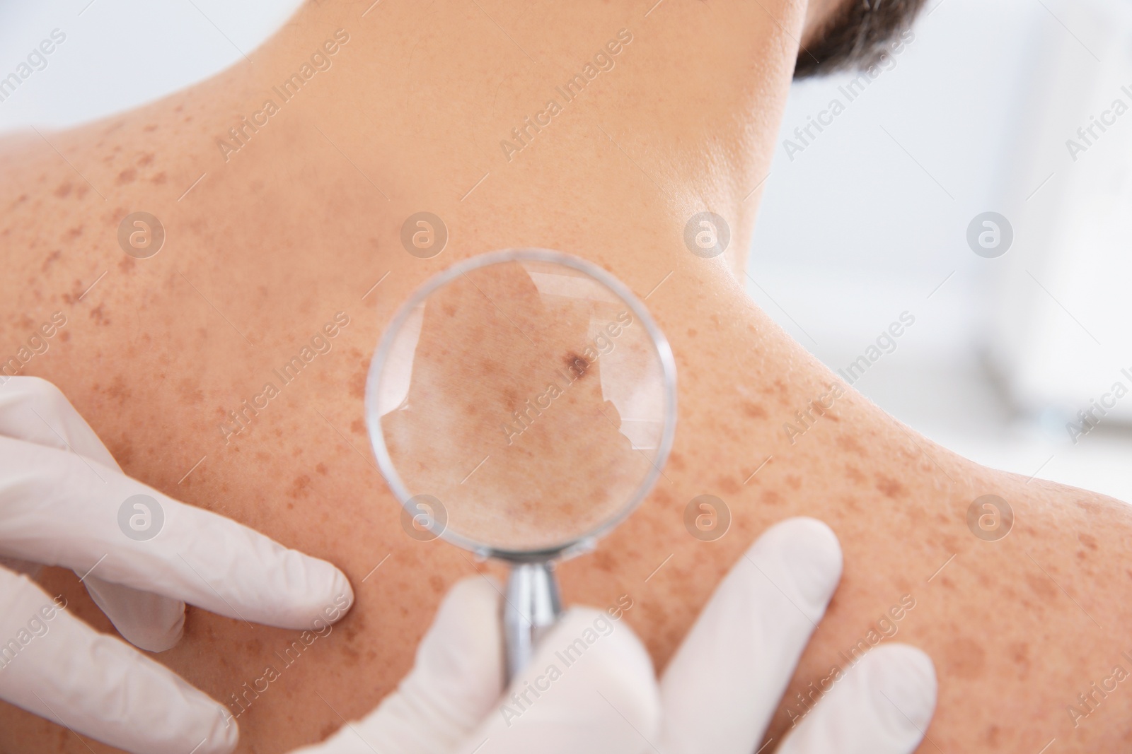 Photo of Dermatologist examining patient's birthmark with magnifying glass in clinic, closeup