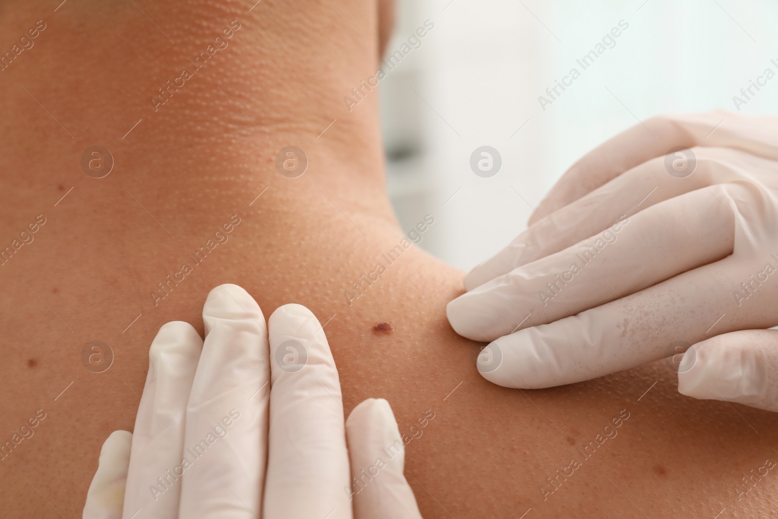 Photo of Dermatologist examining patient's birthmark in clinic, closeup