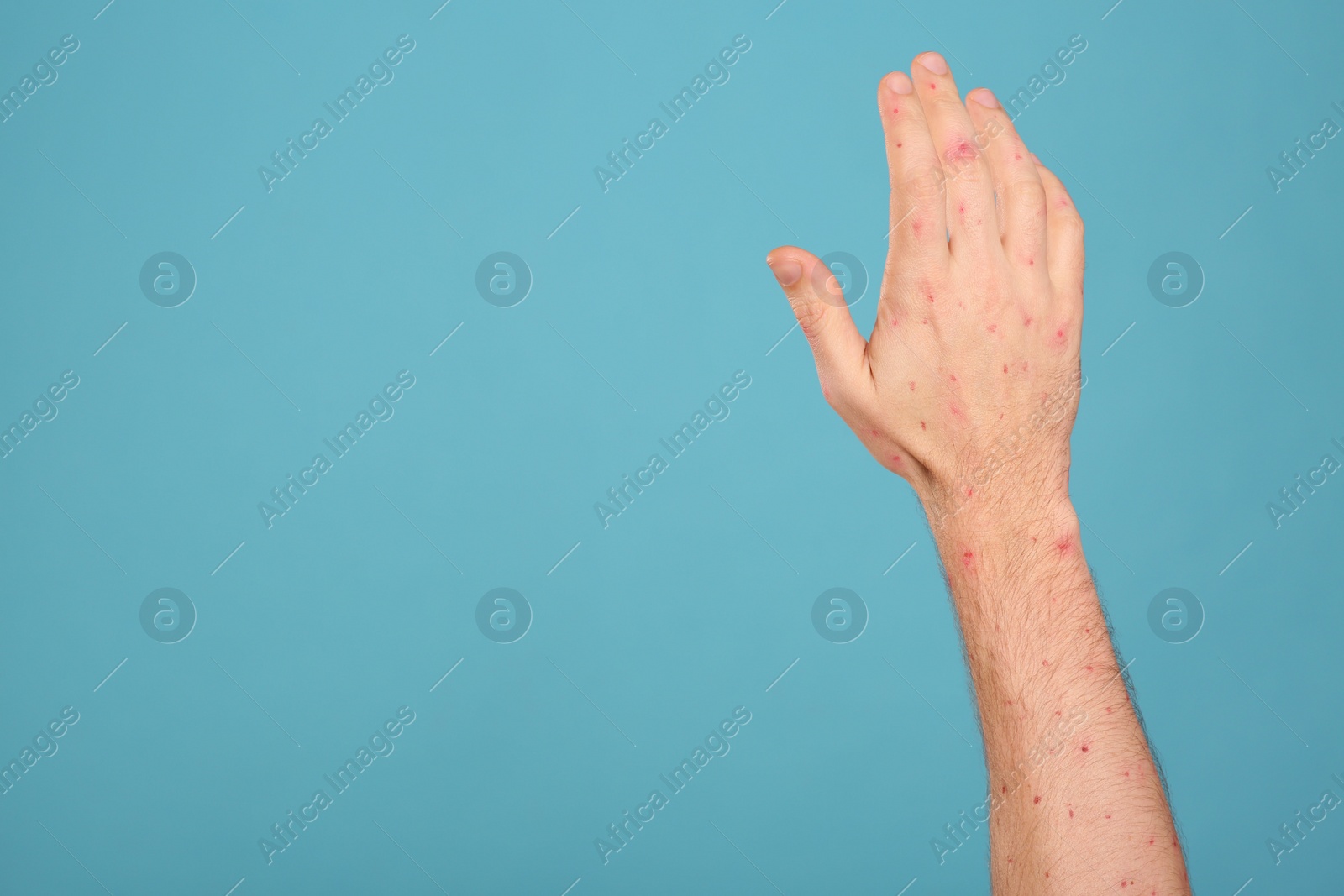 Photo of Man with rash suffering from monkeypox virus on light blue background, closeup. Space for text