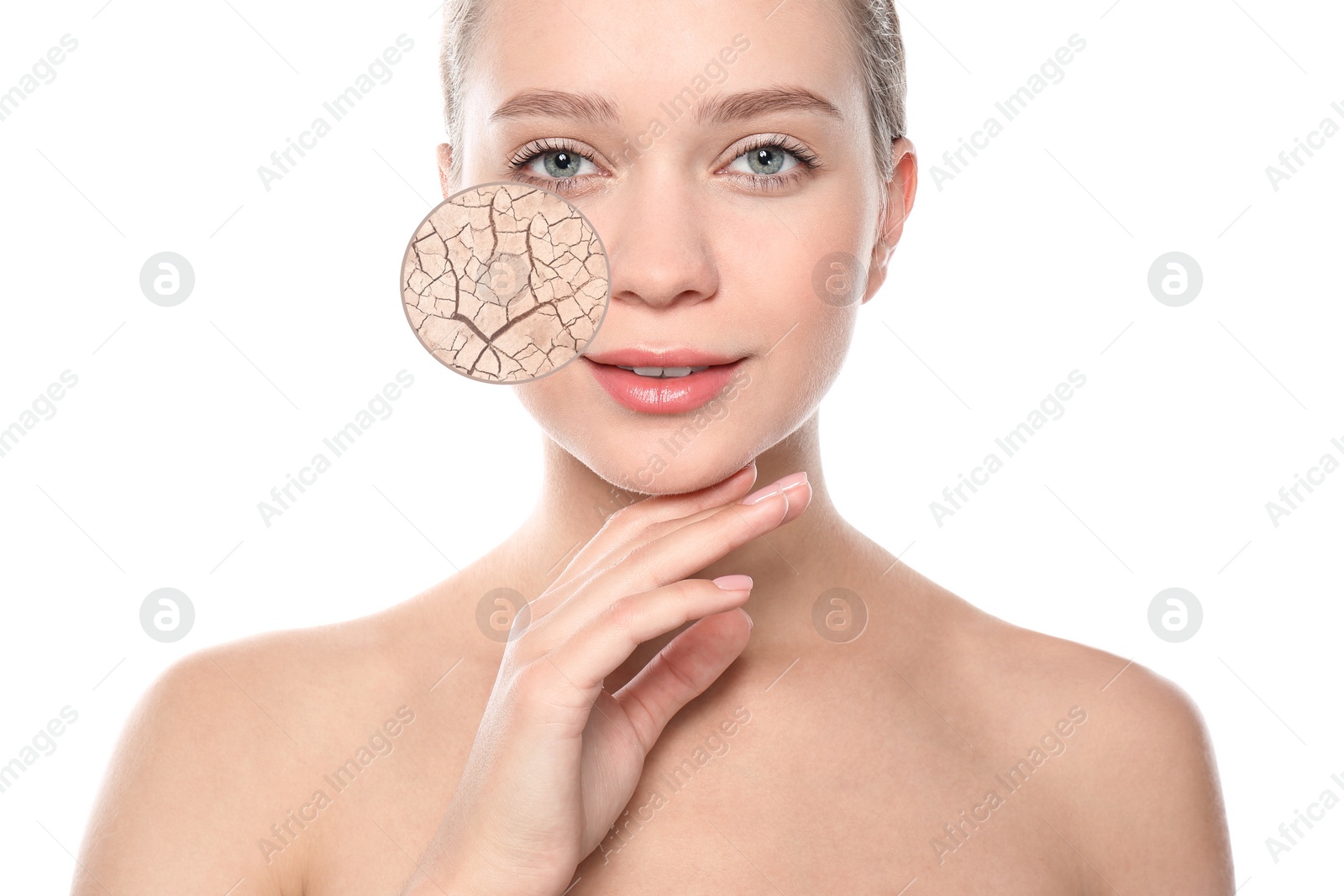 Image of Young woman with facial dry skin problem on white background