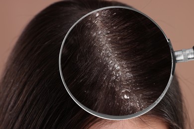 Woman suffering from dandruff on pale brown background, closeup. View through magnifying glass on hair with flakes