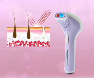 Epilation procedure. Modern appliance and illustration of hair follicles on pink background