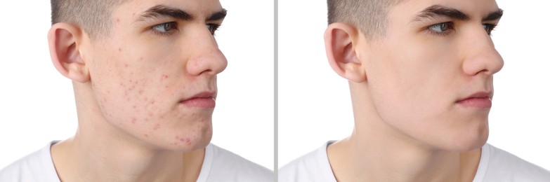 Image of Acne problem. Young man before and after treatment on white background, collage of photos