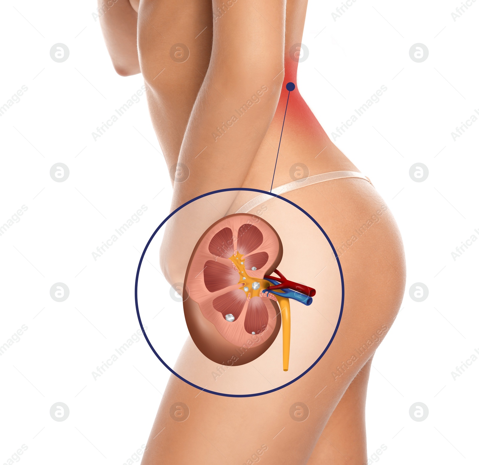 Image of Woman with kidney stones disease on white background