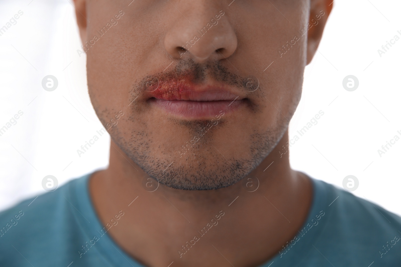 Photo of Man with herpes on lip against light background, closeup
