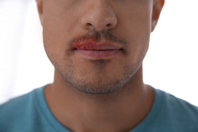 Photo of Man with herpes on lip against light background, closeup