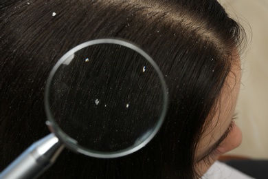 Photo of Closeup of woman with dandruff in her hair, view through magnifying glass