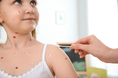 Photo of Woman applying cream onto skin of little girl with chickenpox at home, closeup