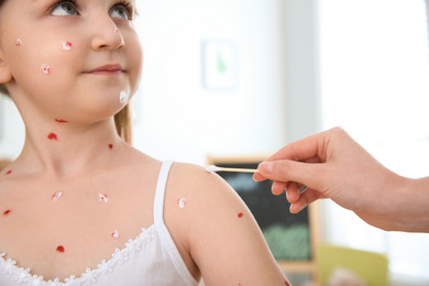 Woman applying cream onto skin of little girl with chickenpox at home, closeup