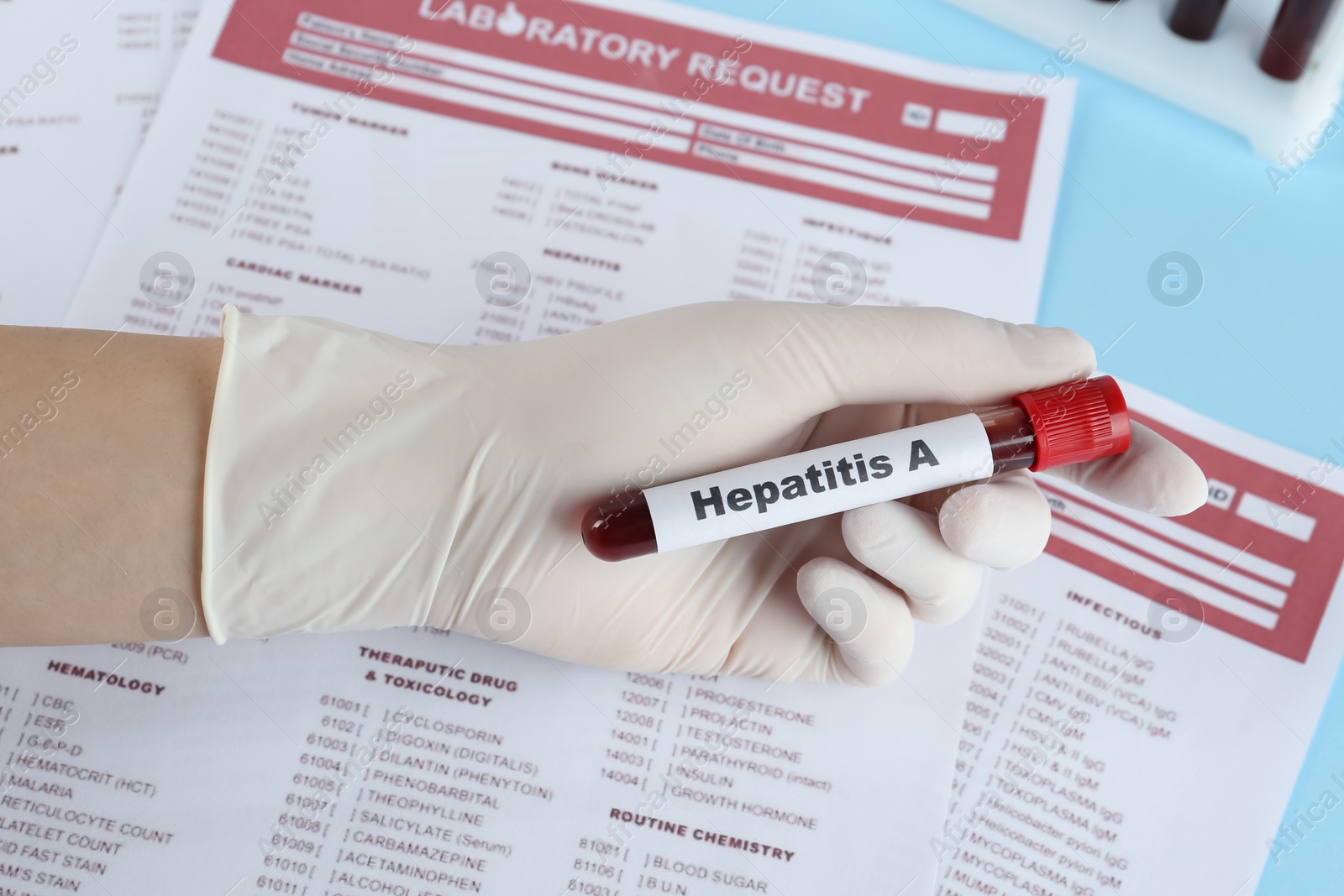 Photo of Scientist holding tube with blood sample and label Hepatitis A near laboratory test form, closeup