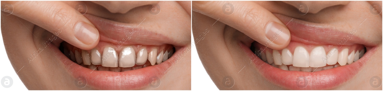 Image of Collage with photos of young woman before and after dental treatment, closeup. Banner design