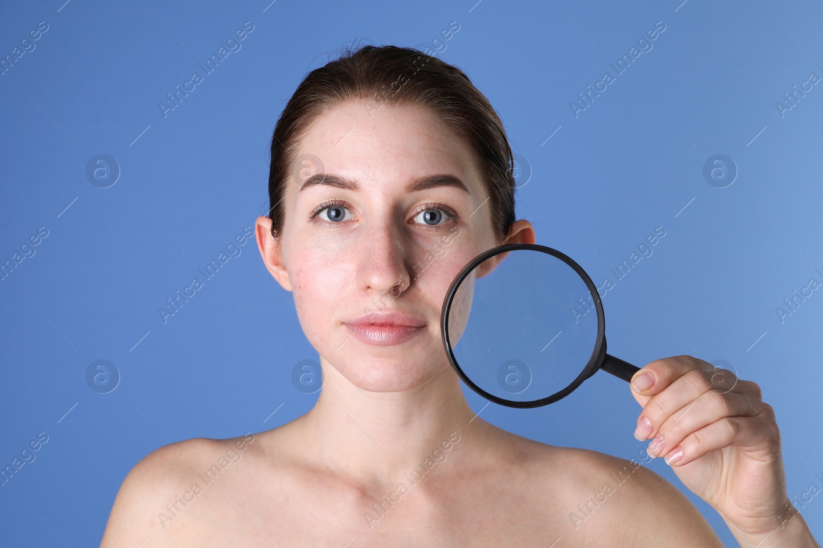 Photo of Young woman with acne problem holding magnifying glass near her skin on blue background