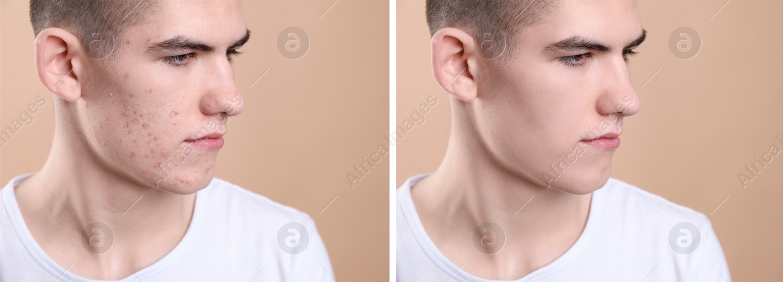 Image of Acne problem. Young man before and after treatment on beige background, collage of photos
