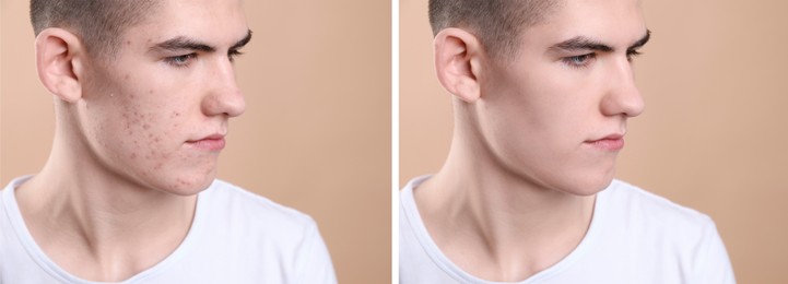 Acne problem. Young man before and after treatment on beige background, collage of photos