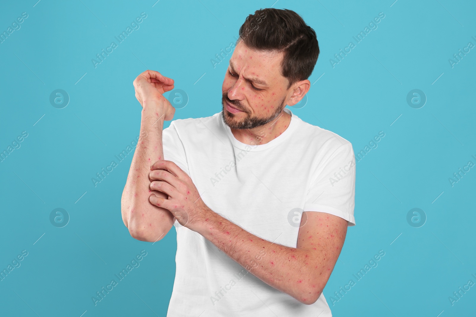 Photo of Man with rash suffering from monkeypox virus on light blue background