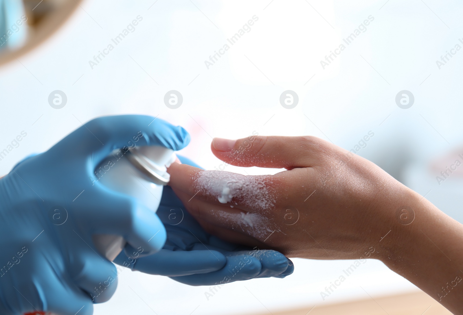 Photo of Applying burn spray onto injured skin, closeup