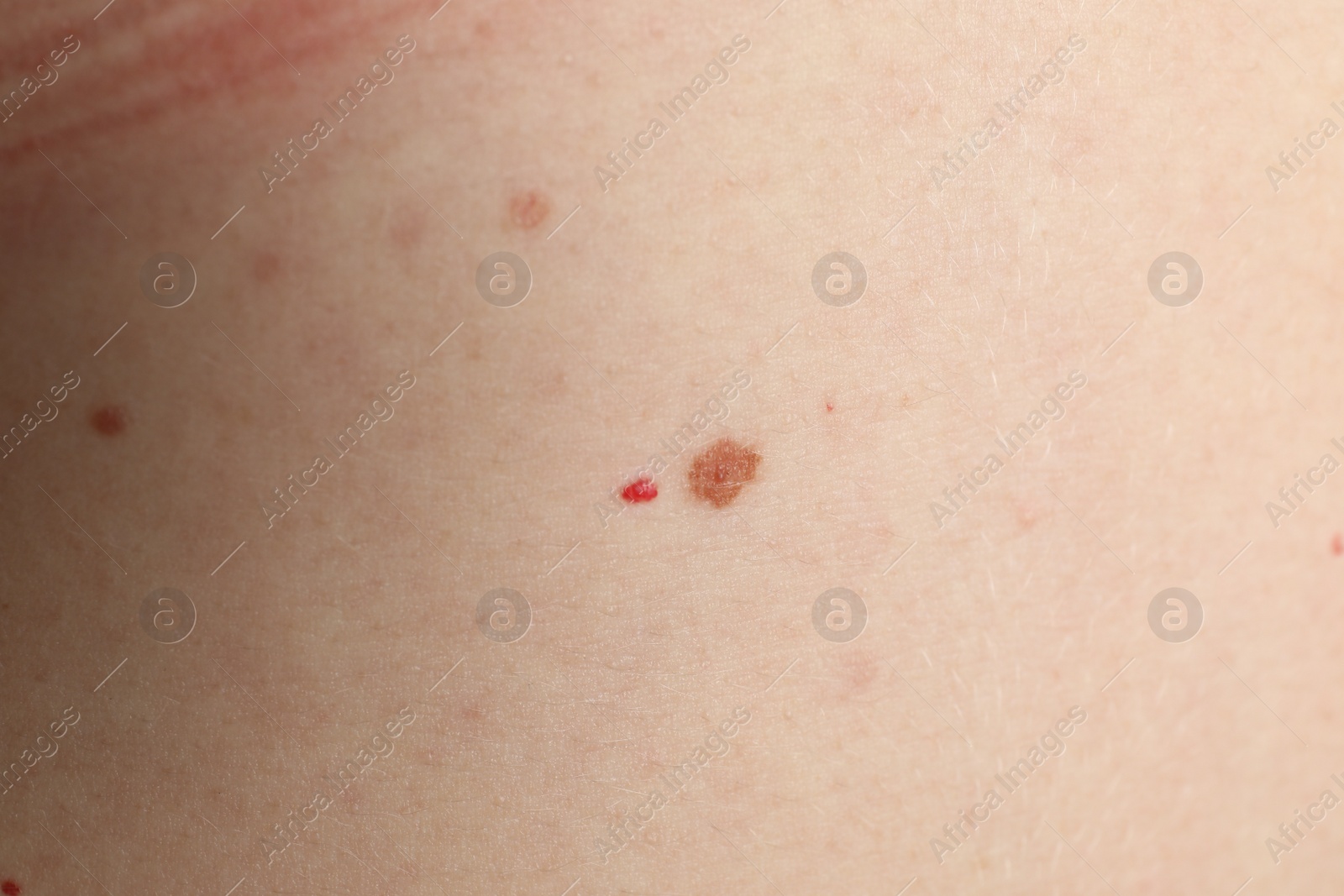 Photo of Closeup view of woman's body with birthmarks as background